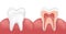 Healthy white tooth, gums and bone illustration, detailed anatomy. Tooth anatomy infographics. Realistic White Tooth Mockup.