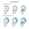 Hearing aids types