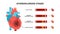 Heart attack and atherosclerosis stages. Healthy artery, beginning cholesterol plaque, advanced cholesterol plaque