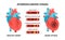 Heart attack and atherosclerosis stages. Healthy and unhealthy arteries. Cholesterol in the blood vessels.