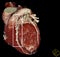 Heart bypass surgery. CT-scan reconstruction