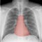 Heart on chest X-ray