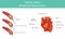 Heart Diamond Angioplasty. Illustration infographic.