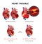 Heart disease vector infographics