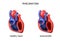 Heart healthy and diseased endocarditis