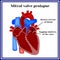 Heart structure. Mitral valve prolapse. Cardiac pathology