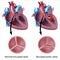 Heart valve defect