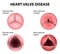 Heart valve disease