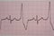 Heartbeats recorded on an electrocardiogram. cardiac arrhythmia