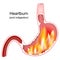 Heartburn. Cross section of a stomach with flame