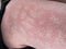 Heat rash hives allergy reaction knee close-up reference picture of blotchy mottled red skin erythema ab igne also known as EAI