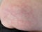 Heat rash hives allergy reaction knee close-up reference picture of blotchy mottled red skin erythema ab igne also known as EAI