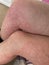 Heat rash hives allergy reaction knee close-up reference picture of blotchy mottled red skin erythema ab igne also known as EAI