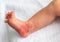 Hemangioma red birthmark on the leg of newborn baby