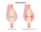 Hemarthrosis in the synovial joint