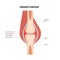 Hemarthrosis in the synovial joint