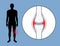 Hemarthrosis in the synovial joint