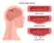 Hemorrhagic brain stroke. Damaged human brain,weakend and ruptured