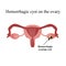 Hemorrhagic cyst on the ovary. Ovary.