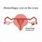 Hemorrhagic cyst on the ovary. Ovary. Infographics. illustration