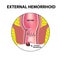 Hemorrhoids external. Rectum structure. Intestines. colon. Internal hemorrhoidal node. Infographics. Vector illustration