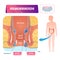 Hemorrhoids vector illustration. Labeled anatomical vascular piles scheme.