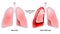 Hemothorax. Healthy human lungs and red lungs after accumulation of blood within the pleural cavity