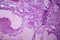 Hepatic cavernous hemangioma, light micrograph