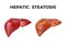 Hepatic steatosis is a disorder characterized by the accumulation of fat inside the liver cells