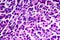 Hepatocellular carcinoma, light micrograph