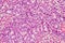 Hepatocellular carcinoma - liver cancer in rat, 60x zoom