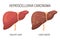 Hepatocellular carcinoma, liver diseases. Healthy liver and liver cancer. Medical infographic banner.