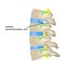 A hernia of the intervertebral disc. Vector illustration on isolated background.