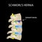 Hernia Schmorl. Intervertebral disc. Side view. Spine. Infographics. Vector illustration on a black background