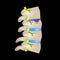 Hernia Schmorl. Intervertebral disc. Side view. Spine. Infographics. Vector illustration on a black background