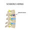 Hernia Schmorl. Intervertebral disc. Side view. Spine. Infographics Vector illustration on isolated background