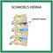 Hernia Schmorl. Intervertebral disc. Side view. Spine. Infographics Vector illustration on isolated background