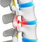 Herniated disk