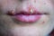 Herpes disease on the lips of a young girl