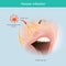 Herpes Infection. Illustration human facial nerve skin for use explain herpes.