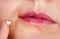 Herpes on the lip close-up macro. Woman lubricates the labial herpes ointment
