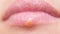 Herpes on lips