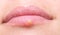 Herpes on lips