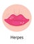 Herpes lips vector. Simplex virus infection causes recurring episodes of small, painful, fluid-filled blisters on skin