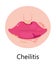 Herpes lips vector. Simplex virus infection causes recurring episodes of small, painful, fluid-filled blisters on skin