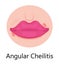 Herpes lips vector. Simplex virus infection causes recurring episodes of small, painful, fluid-filled blisters on skin