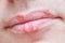 Herpes simplex virus infection on male face lips