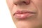 Herpes virus. Herpes disease on the lips of a 30 year old woman. Infectious virus. Close-up of the manifestation of herpes on the