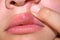 Herpes virus on the lip