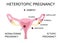 Heterotopic Pregnancy. extra-uterine ectopic pregnancy and intrauterine pregnancy occur simultaneously